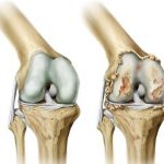 Bolovi u zglobovima - Uzroci, Simptomi i Prirodni Tretmani
