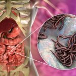 Efikasna Rješenja za Crijevne Parazite