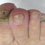 Mikoza noktiju Rješenja i prevencija