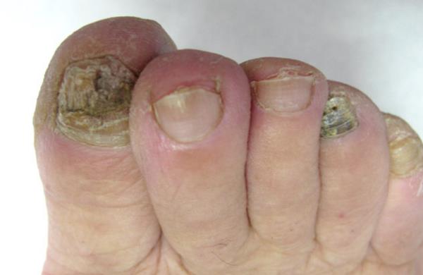 Mikoza noktiju Rješenja i prevencija