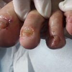 Mikoza noktiju - Uzroci, simptomi i učinkoviti prirodni tretmani