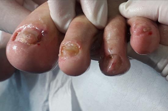 Mikoza noktiju - Uzroci, simptomi i učinkoviti prirodni tretmani