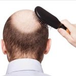 Najbolji Prirodni Tretmani za Gubitak Kose