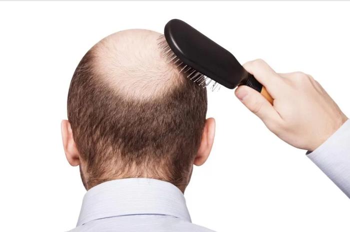 Najbolji Prirodni Tretmani za Gubitak Kose