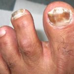 Najbolji prirodni tretmani za gljivice na noktima