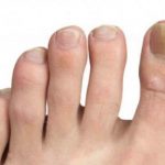 Najbolji prirodni tretmani za gljivice na stopalima