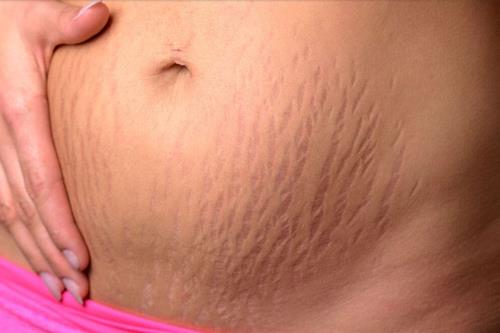 Najbolji prirodni tretmani za uklanjanje celulita, hidrataciju kože i mršavljenje