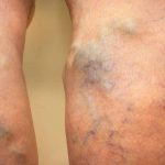 Najbolji tretmani za varikozne vene - Prirodni, medicinski i kirurški pristupi