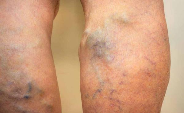 Najbolji tretmani za varikozne vene - Prirodni, medicinski i kirurški pristupi