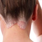 Prirodni načini za liječenje psorijaze - Najbolji savjeti i tretmani