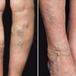 Prirodni tretmani za proširene vene