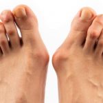 Učinkovit tretman za Hallux Valgus