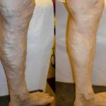 Učinkovito liječenje proširenih vena