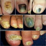 Dermatofiti i mikoza - Razumijevanje vrsta gljivičnih infekcija i njihovih simptoma