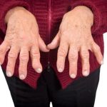 Prevence a léčba artritidy - Jak udržet klouby zdravé